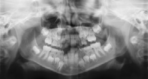 Dental Radiographs (X-Rays) - Pediatric Dentist in Littleton, CO