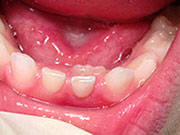 Baby Teeth - Pediatric Dentist in Littleton, CO