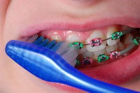 Brushing Your Braces