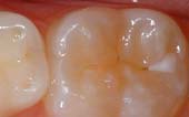 Sealant-Before - Pediatric Dentist in Littleton, CO