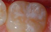 Sealant-After - Pediatric Dentist in Littleton, CO